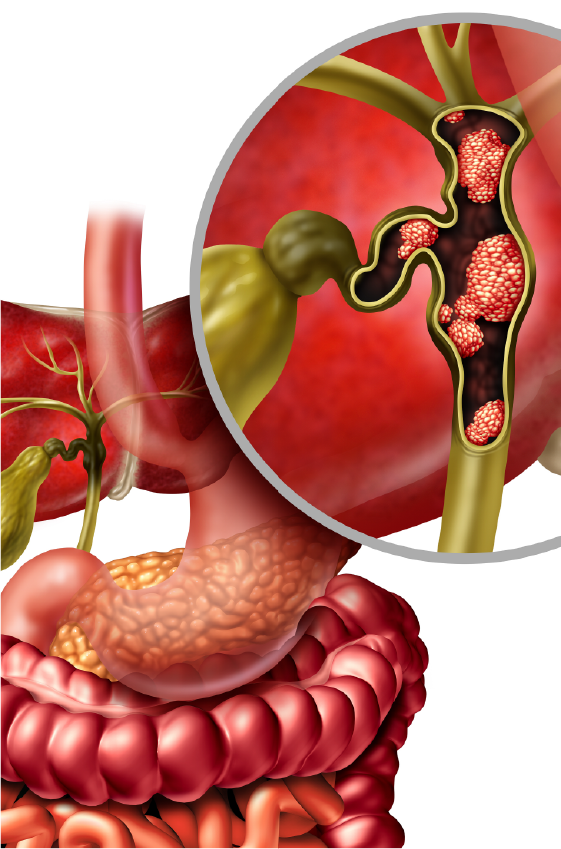 Pemazyre Pemigatinib The First Fda Approved Treatment For Pemazyre Pemigatinib The First Fda Approved Treatment For